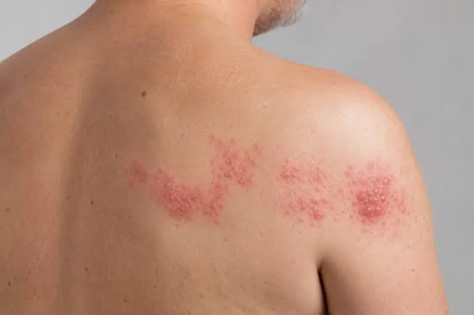 Herpes-zóster cresce no Brasil, já soma 33 mil atendimentos em 2026 e vacina ainda não está no SUS